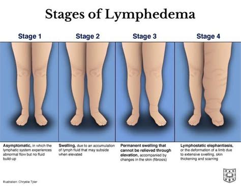 water leaking from leg|Causes & Treatment – Lymphoedema / Oedema of。